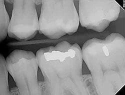 Dental x-ray