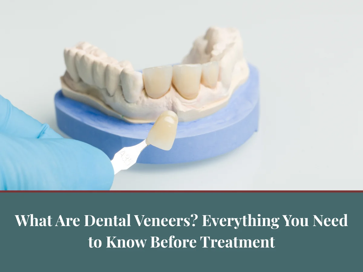 What Are Dental Veneers? Everything You Need to Know Before Treatment